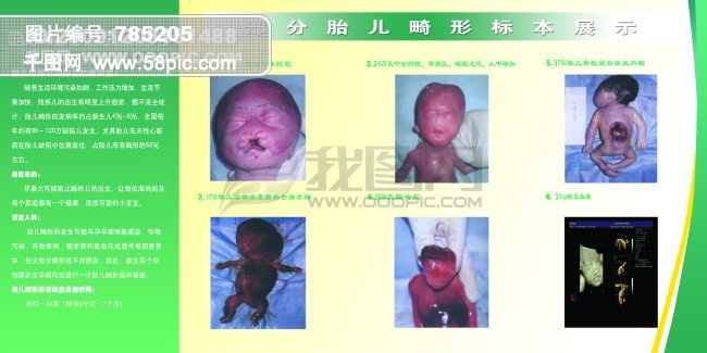 胎儿彩超筛查 部分胎儿畸形标本展示高清图片